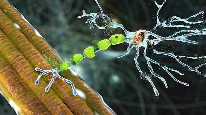 ¿Qué es la esclerosis lateral amiotrófica?