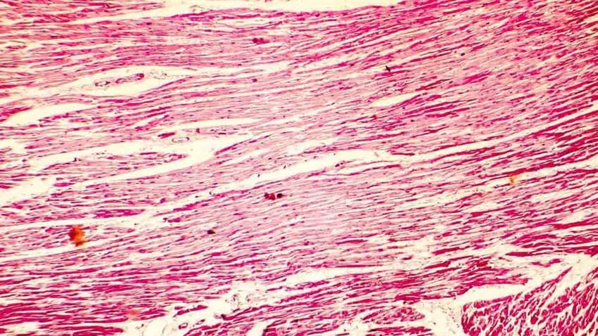 El uso del metoprolol mejora la miocardiopatía hipertrófica obstructiva, según estudio