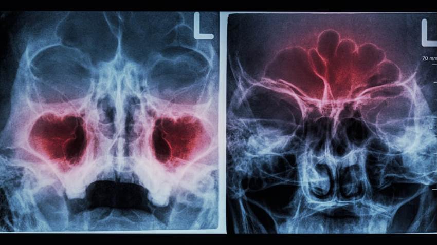 Reconozca los síntomas de la sinusitis y sus diferencias frente a la congestión nasal común