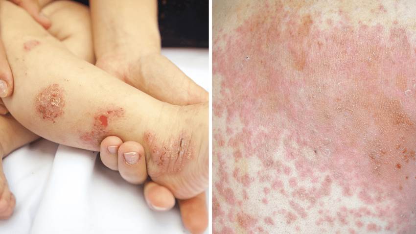 Dermatitis atópica está marcadamente subdiagnosticada por los médicos en Puerto Rico